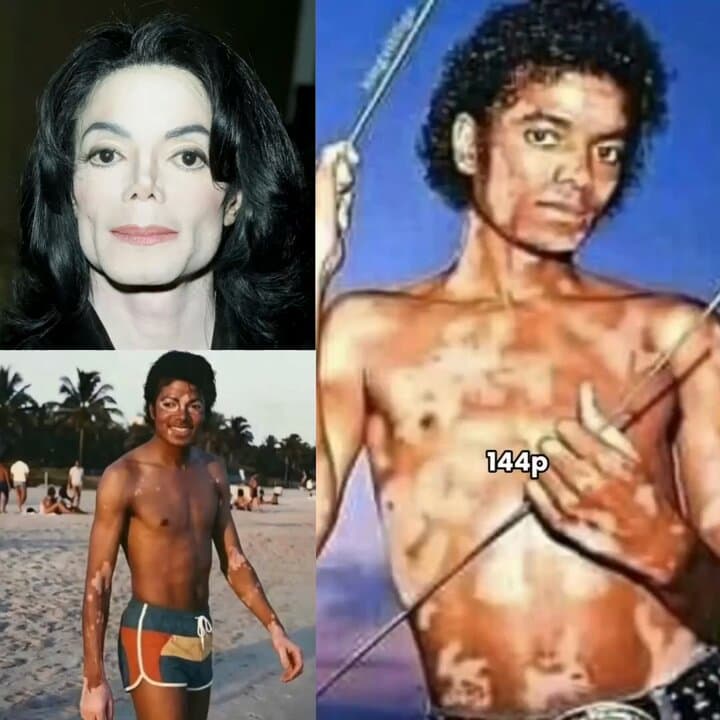 Dancing With The Scandal: Jacksons Skin Disease Exposed By Oprah